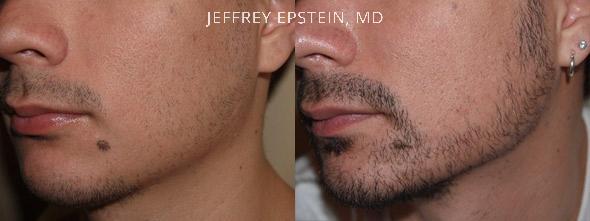Facial Hair Transplant Before and after in Miami, FL, Paciente 36751