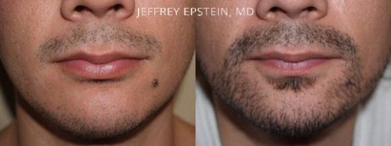 Facial Hair Before and after in Miami, FL, Paciente 36751