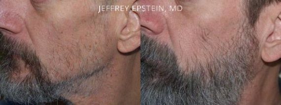 Facial Hair Before and after in Miami, FL, Paciente 36758