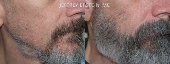 Facial Hair Transplant Before and after in Miami, FL, Paciente 36758
