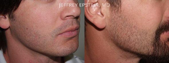 Facial Hair Transplant Before and after in Miami, FL, Paciente 36763