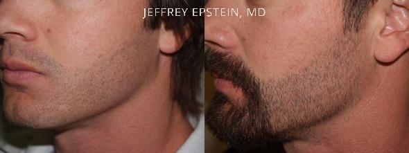 Facial Hair Transplant Before and after in Miami, FL, Paciente 36763
