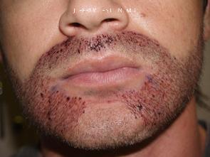 Trasplante de Pelo Facial Antes y después en Miami, FL, Paciente 73248