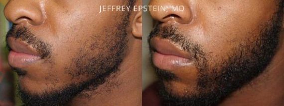 Facial Hair Transplant Before and after in Miami, FL, Paciente 36773