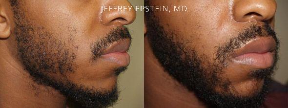Facial Hair Transplant Before and after in Miami, FL, Paciente 36773
