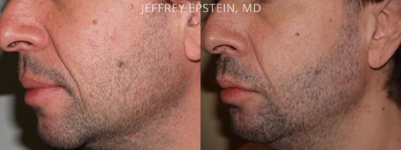 Facial Hair Transplant Before and after in Miami, FL, Paciente 36778