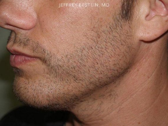 Trasplante de Pelo Facial Before and after in Miami, FL, Paciente 73167
