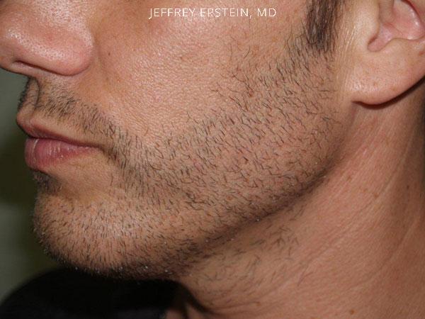 Facial Hair Transplant Before and after in Miami, FL, Paciente 36781