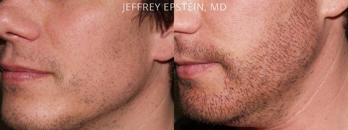 Facial Hair Before and after in Miami, FL, Paciente 36781