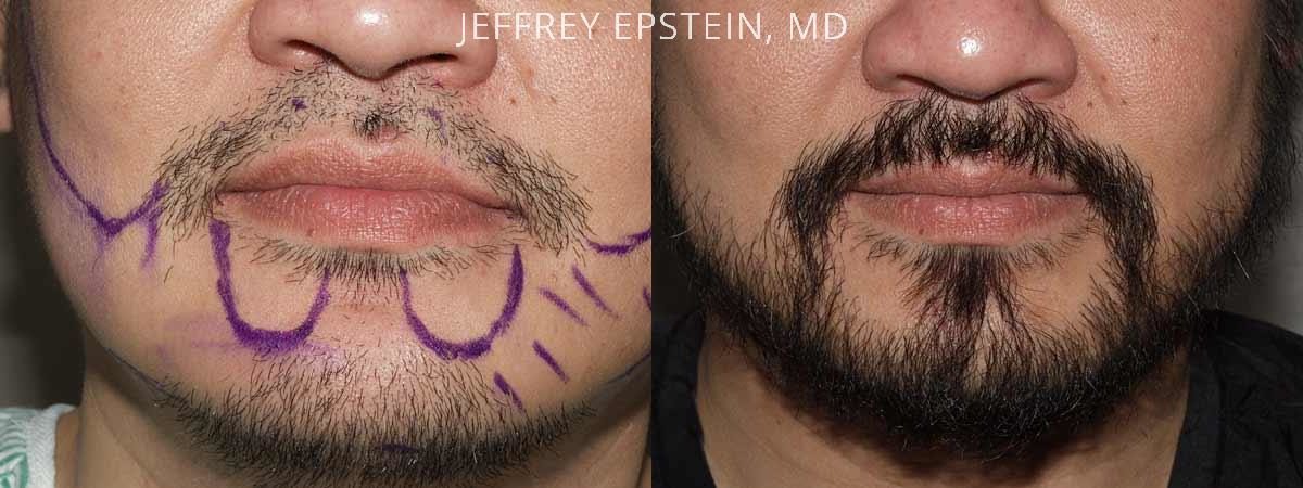 Facial Hair Transplant Before and after in Miami, FL, Paciente 36785
