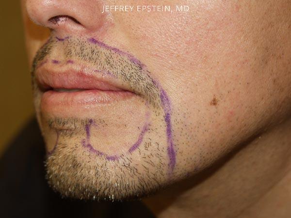 Facial Hair Transplant Before and after in Miami, FL, Paciente 36788