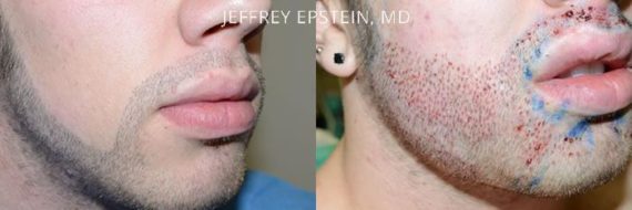 Trasplante de Pelo Facial Before and after in Miami, FL, Paciente 73086