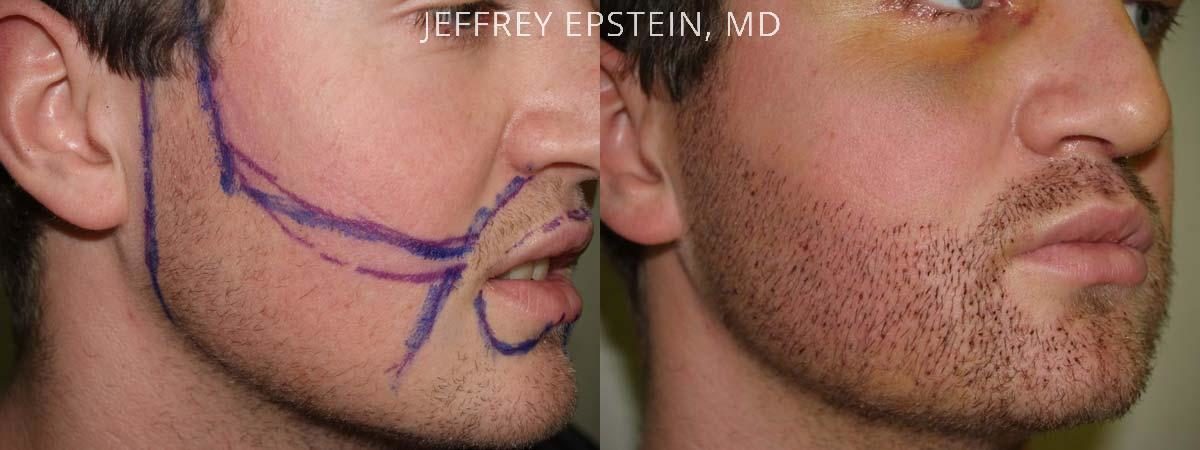 Facial Hair Transplant Before and after in Miami, FL, Paciente 36797