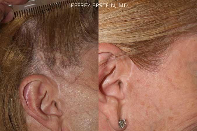 Facial Hair Transplant Before and after in Miami, FL, Paciente 36800