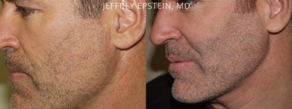 Trasplante de Pelo Facial Before and after in Miami, FL, Paciente 73019