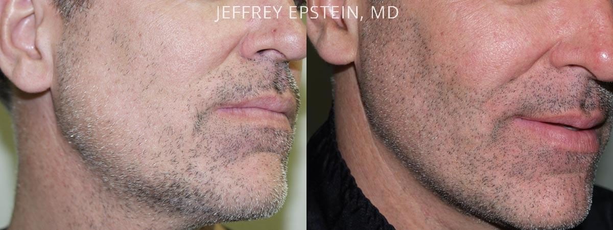Facial Hair Transplant Before and after in Miami, FL, Paciente 36803
