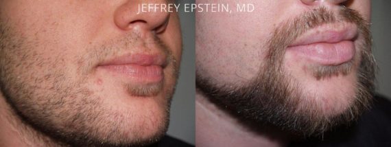 Trasplante de Pelo Facial Before and after in Miami, FL, Paciente 72969