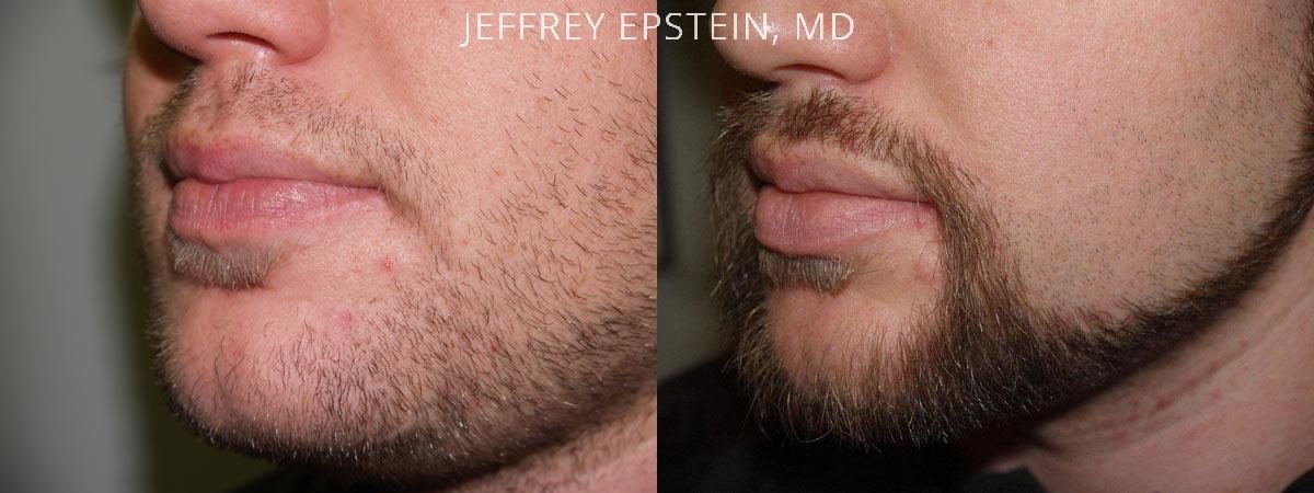 Facial Hair Transplant Before and after in Miami, FL, Paciente 36808