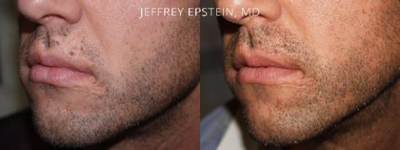 Trasplante de Pelo Facial Before and after in Miami, FL, Paciente 72920