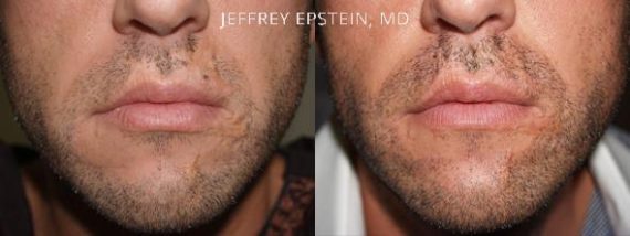 Facial Hair Transplant Before and after in Miami, FL, Paciente 36815