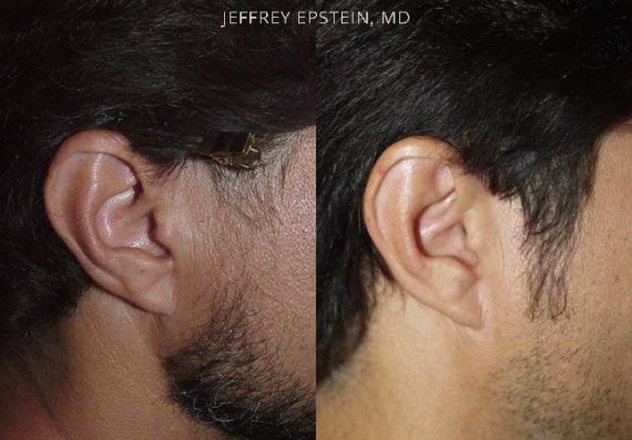 Trasplante de Pelo Facial Before and after in Miami, FL, Paciente 72903