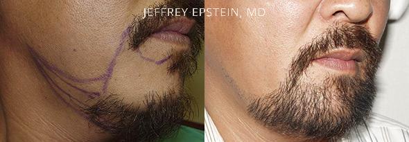 Facial Hair Transplant Before and after in Miami, FL, Paciente 36823