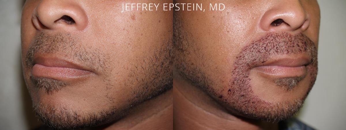 Facial Hair Transplant Before and after in Miami, FL, Paciente 36826