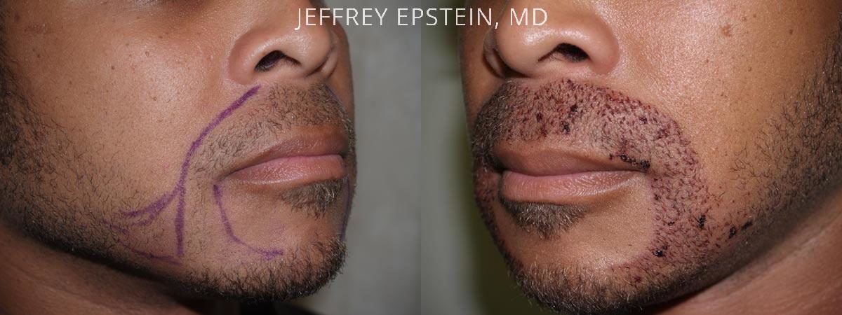 Trasplante de Pelo Facial Antes y después en Miami, FL, Paciente 72832