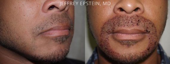 Trasplante de Pelo Facial Before and after in Miami, FL, Paciente 72832