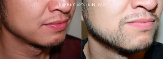 Trasplante de Pelo Facial Before and after in Miami, FL, Paciente 72732