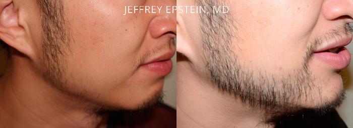 Facial Hair Transplant Before and after in Miami, FL, Paciente 36833