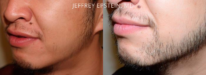 Trasplante de Pelo Facial Antes y después en Miami, FL, Paciente 72732