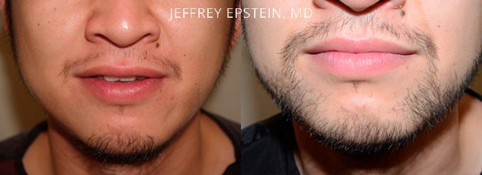 Facial Hair Transplant Before and after in Miami, FL, Paciente 36833