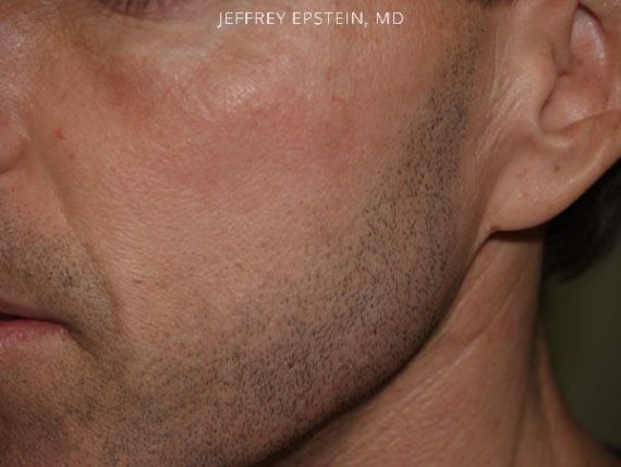 Trasplante de Pelo Facial Before and after in Miami, FL, Paciente 72686