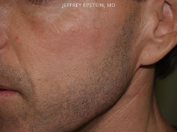 Facial Hair Transplant Before and after in Miami, FL, Paciente 36845