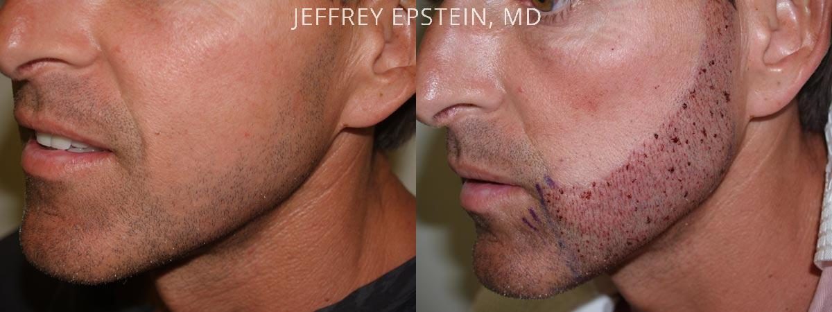 Facial Hair Transplant Before and after in Miami, FL, Paciente 36845