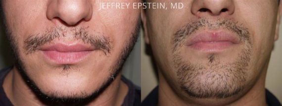 Trasplante de Pelo Facial Before and after in Miami, FL, Paciente 72653