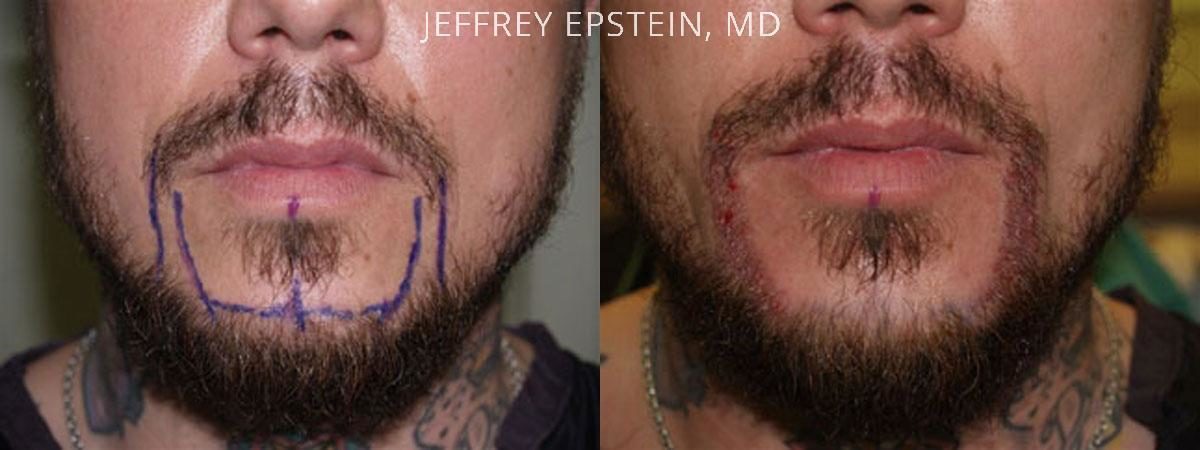 Trasplante de Pelo Facial Antes y después en Miami, FL, Paciente 72622