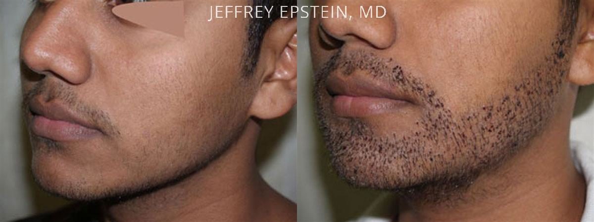 Trasplante de Pelo Facial Antes y después en Miami, FL, Paciente 72589