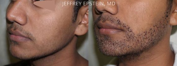 Trasplante de Pelo Facial Before and after in Miami, FL, Paciente 72589