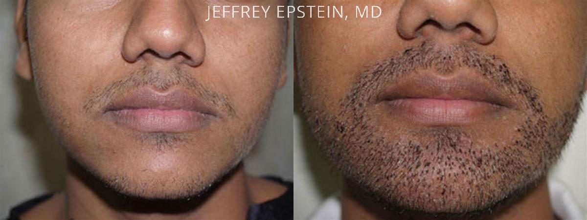 Facial Hair Transplant Before and after in Miami, FL, Paciente 36859