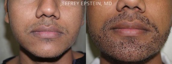 Trasplante de Pelo Facial Before and after in Miami, FL, Paciente 72589