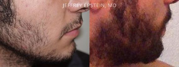 Trasplante de Pelo Facial Before and after in Miami, FL, Paciente 72540