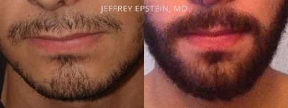 Trasplante de Pelo Facial Before and after in Miami, FL, Paciente 72540