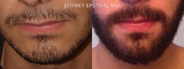 Facial Hair Transplant Before and after in Miami, FL, Paciente 36864