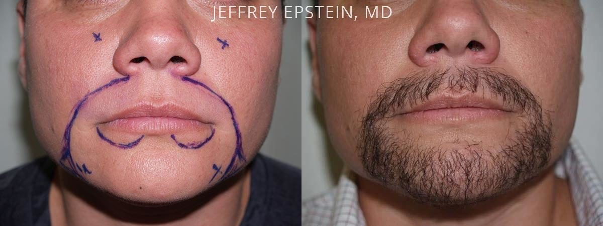 Facial Hair Transplant Before and after in Miami, FL, Paciente 36871