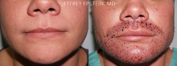 Facial Hair Transplant Before and after in Miami, FL, Paciente 36871