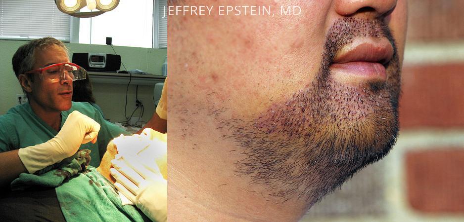 Facial Hair Transplant Before and after in Miami, FL, Paciente 36876