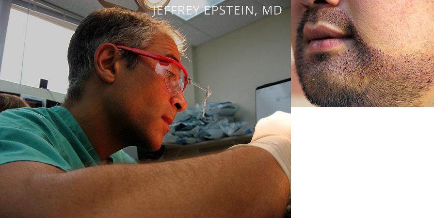 Facial Hair Transplant Before and after in Miami, FL, Paciente 36876