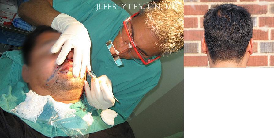 Trasplante de Pelo Facial Antes y después en Miami, FL, Paciente 72390